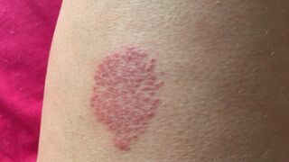 Stung and Sensitive: Treating My Jellyfish Marks with Bare Hands