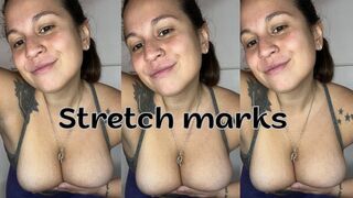 Stretch mark fetish