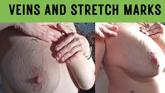 stretch mark fetish