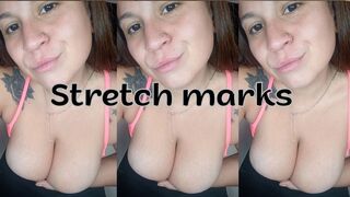 Stretch marks on my tits