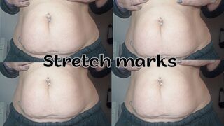 Stretch marks on my belly