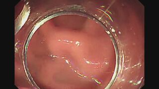 Endoscope Progression