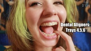 Dental Aligners : Tray 4 5 and 6