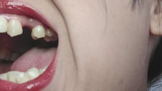 Guess how many molars l'm missing