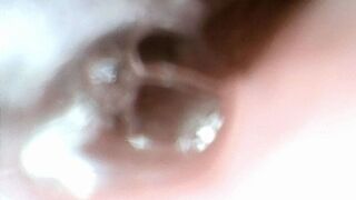 cherry tomatos endo stomach cam