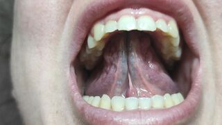 Crooked teeth and without molars