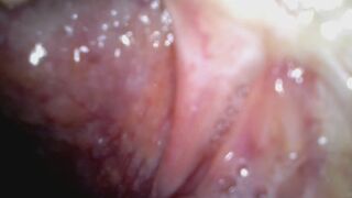 Holy uvula Endoscope camera used