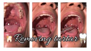 Removing tartar from my throat