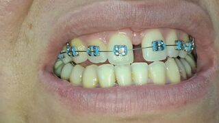 The imperfections of my teeth with my braces