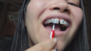 “POV: I’ll show you my braces and how I clean them up close