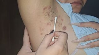 axilas llena de ampollas