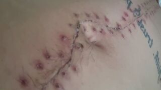 Scar Fetishes Stitches Staples Hospital Recovery After Surgery Teen Petite Small Waist