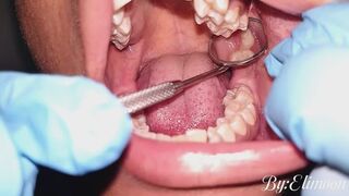 Showing you how my wisdom teeth have progressed!