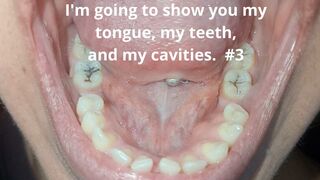 I'm going to show you my tongue, my teeth, and my cavities. #3